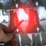 GSK Hansoh ADC ris-rez Phase III კლინიკური კვლევა ონკოლოგია