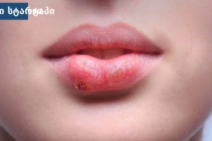 ტუჩზე არსებული წყლული, საქართველო
